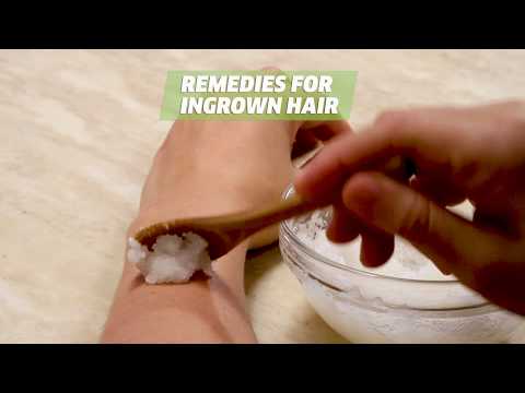 How To Get Rid Of And Remove Ingrown Hair Easy!