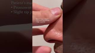 Download lagu Male Rhinoplasty Before & After #Shorts mp3