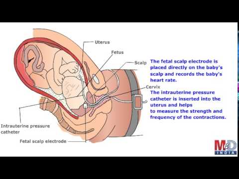 Electronic Fetal Monitoring