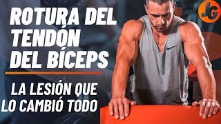 ROTURA  del TENDÓN del BÍCEPS ► MI EXPERIENCIA