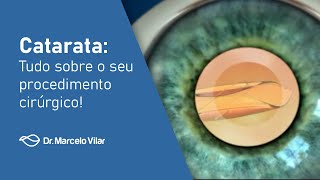 Catarata: Tudo sobre o seu procedimento cirúrgico! - Vídeos | Dr. Marcelo Vilar