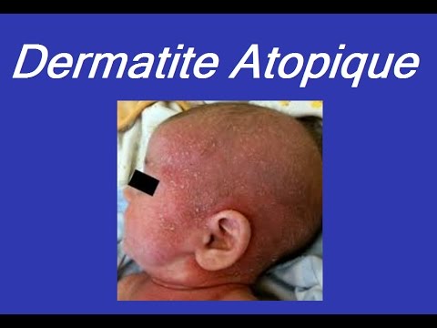 Malattia dermatological eczema D pantenol unguento a dermatite atopic