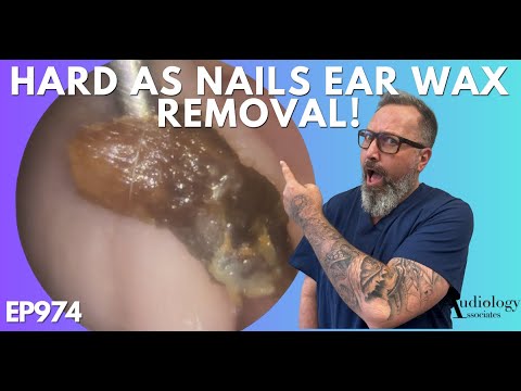 HARD AS NAILS EAR WAX REMOVAL - EP974