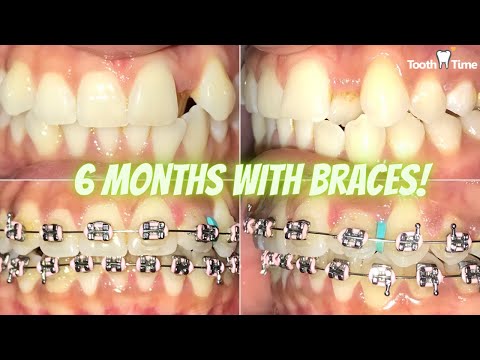 Braces Checkups - 6 months progress GREAT Results- Tooth Time Family Dentistry New Braunfels Texas