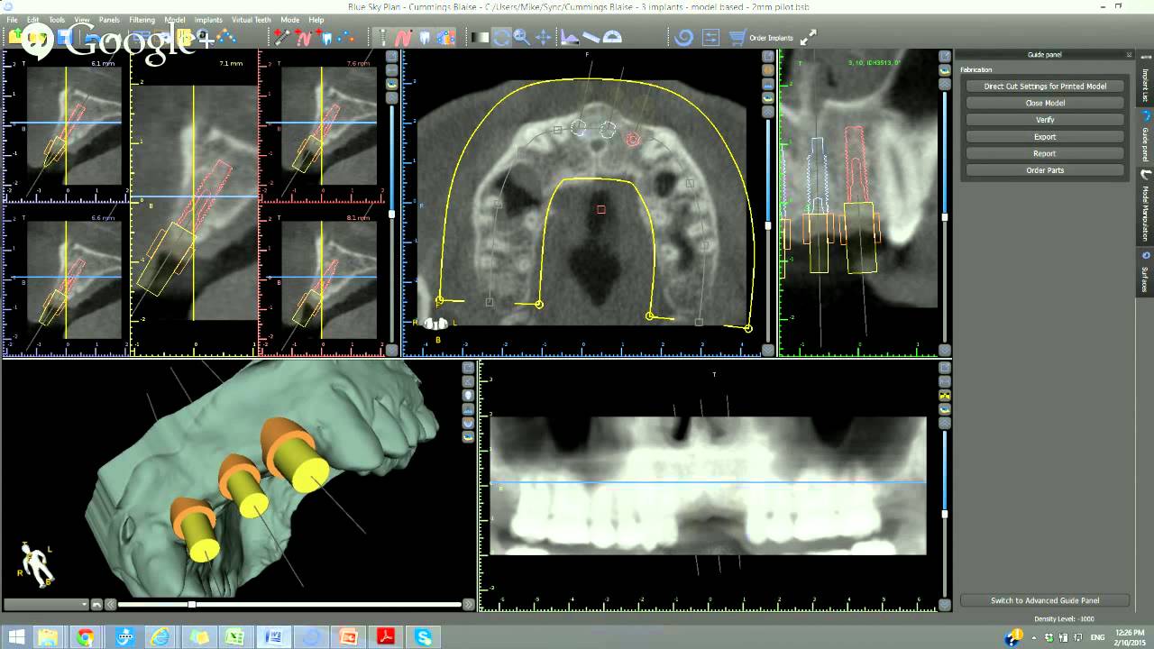 In House Model Based Guide Fabrication