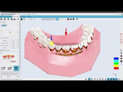 Etching guide for attachment placement