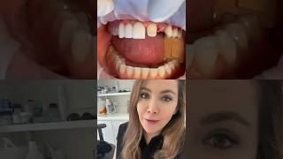 Dental Bridge For Front Teeth!