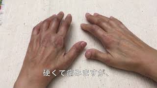 【強皮症 リウマチ】７月のまとめ：オタワの専門医に診察拒否され… ／手と足の可動域