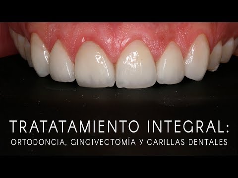 Tratamiento integral: ortodoncia, gingivectomía, carillas estéticas