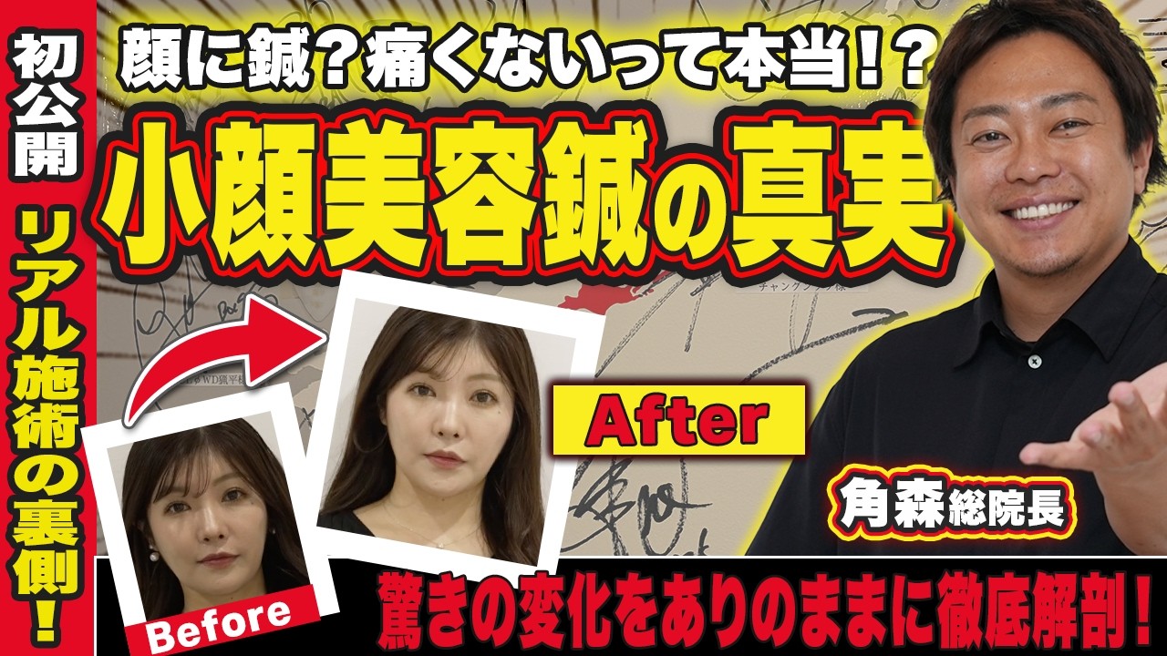 【ここまで変わる】小顔美容鍼のリアルな裏側を初公開