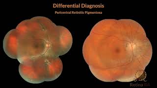 Pigmented Paravenous Retinochoroidal Atrophy