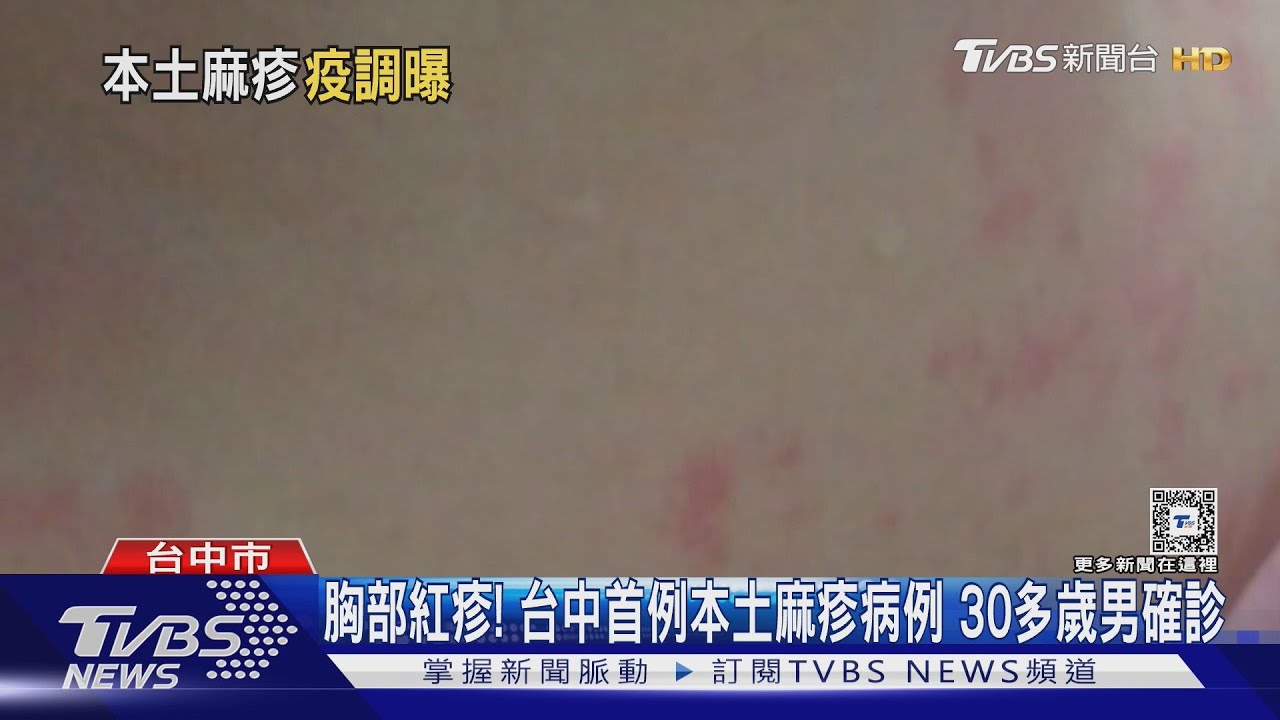胸部紅疹!台中首例本土麻疹病例 30多歲男確診