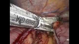 preview picture of video 'Azagra & Goergen Laparoscopic sleeve gastrectomy by 3 trocars 5,5,12mm'