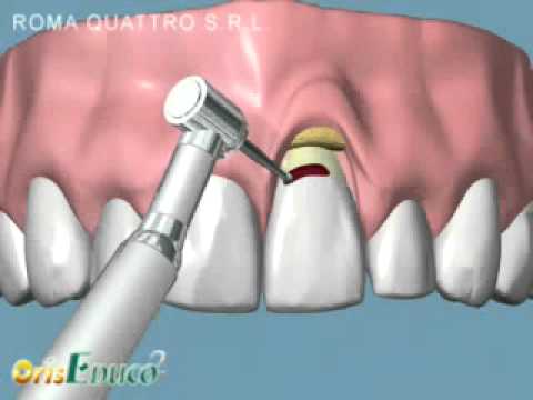 Mal di schiena nei muscoli del sigillo Trattamento per lartrosi cervicale rimedi popolari