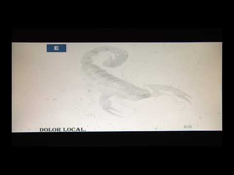 Intoxicación por Picadura de Alacrán