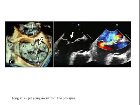 3D Echocardiographic Assessment of Mitral Valve Disease 