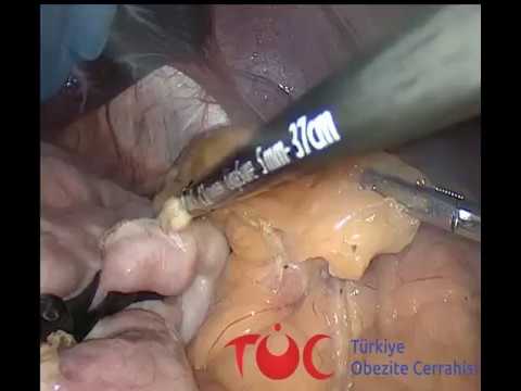 Tüp Mide Ameliyatı - Op. Dr. Cem Arslan - Türkiye Obezite Cerrahisi