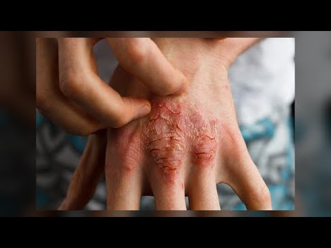 Das Ekzem auf den Beinen wegen Venen Nicht die hormonalen Cremes beim Ekzem