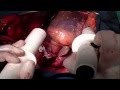 How Surgeons Make A New Heart Beat