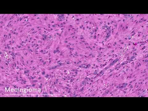 Stimulated Raman Histology Workflow, Daniel Orringer and Chris Freudiger - watch on YouTube