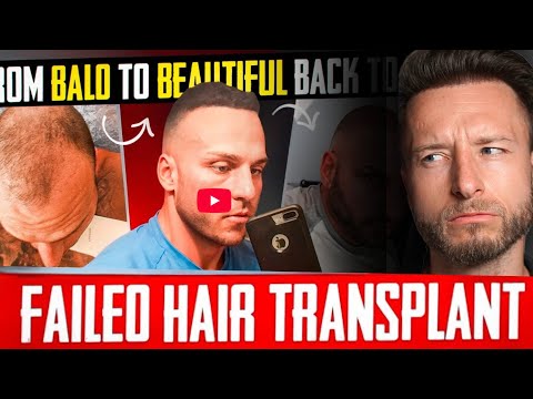 Two $18.000 Hair Transplants Failed! My Reaction