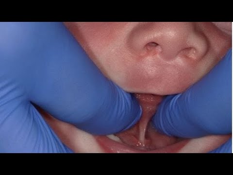 Children born with tongue-tie may suffer difficulty with nursing, speech