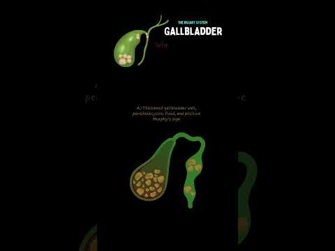 Do You Know Your Gallbladder Basics? 🤔 | Murphy’s Sign & Gallstones Quiz 🩺 #ardms #ultrasound