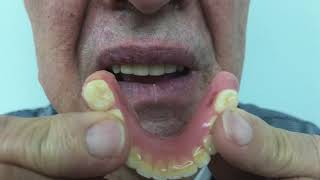 Snap-on-4 teeth 020 @Jewel Dental
