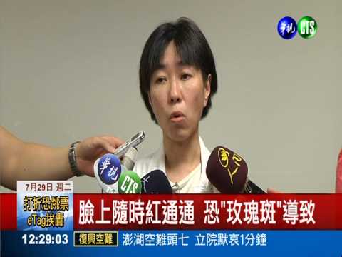 激動容易臉紅?! 恐"玫瑰斑"作怪