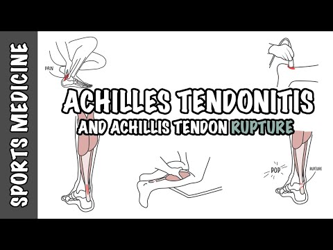 Tendinitis de Aquiles y rotura del tendón: descripción general