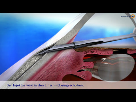XEN Gel Stent Implantat - Operationsmethode für den Grünen Star (Glaukomtherapie) | MUNICH EYE