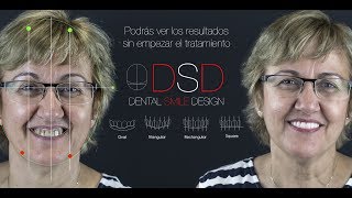 DSD Diseño Digital Sonrisa en Madrid, Antes y Despues. - Avance Dental 