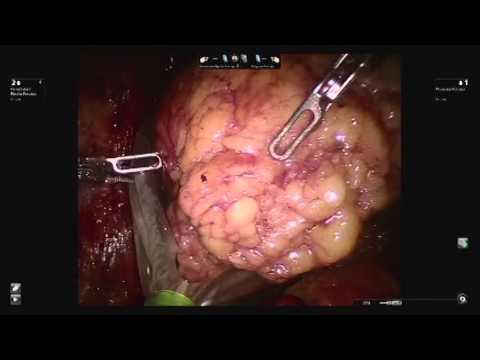 Renal Cell Carcinoma