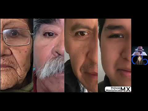 Prótesis ocular y Orbitofacial