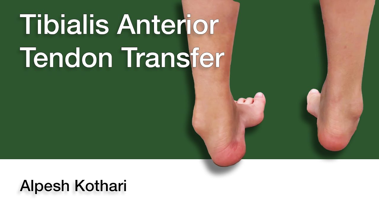 Tibialis Anterior Tendon Transfer