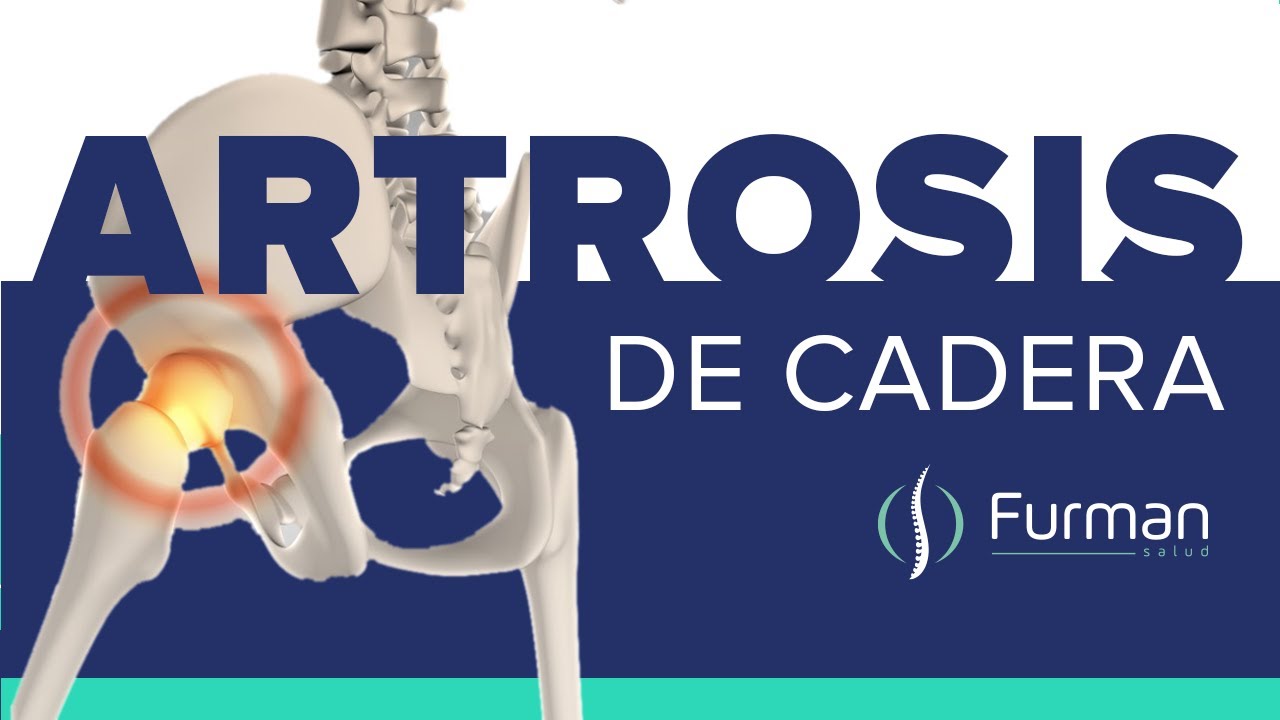 ARTROSIS DE CADERA 😡 dolor de cadera | tratamientos naturales [osteoartritis de cadera]