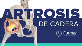 ARTROSIS DE CADERA 😡 dolor de cadera | tratamientos naturales [osteoartritis de cadera]