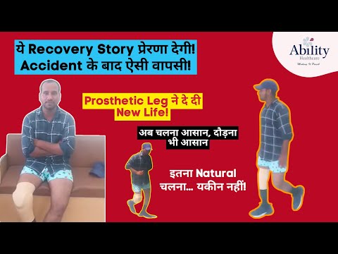 Below Knee Carbon Fibre Prosthesis, Functional Prosthetic