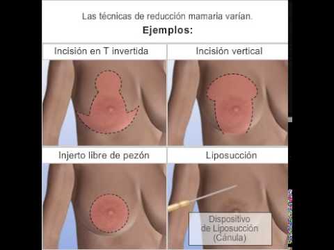 High‑Quality Breast Reduction Mexico: Complete Guide & Honest Cost Breakdown