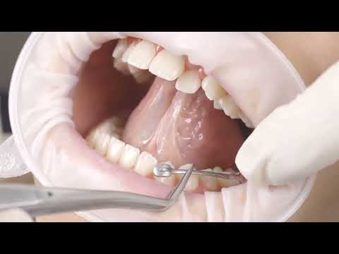 Carriere Motion Class III Appliance