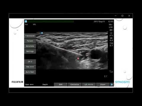 Behind the Scan Webinar: Ultrasound Guided Adductor Canal and iPACK Blocks for Knee Surgery