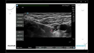 Ultrasound-Guided Adductor Canal and iPACK Blocks for Knee Surgery