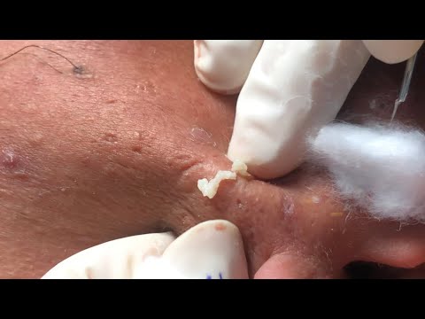In this video there are countless acne – by Mai ngọc