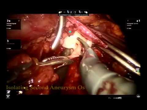Robotic Management of Large Renal Artery Aneurysm