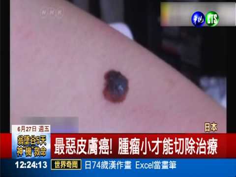 治療皮膚癌新藥 黑色素瘤有救!