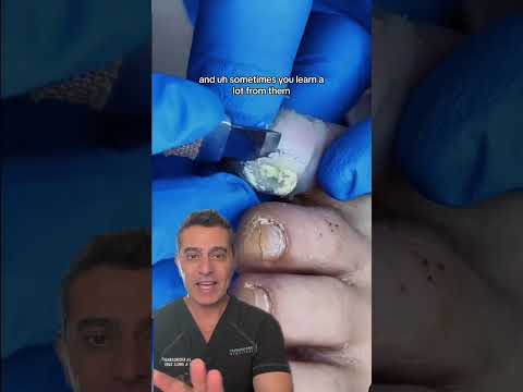 Removing A Wart With ACID?