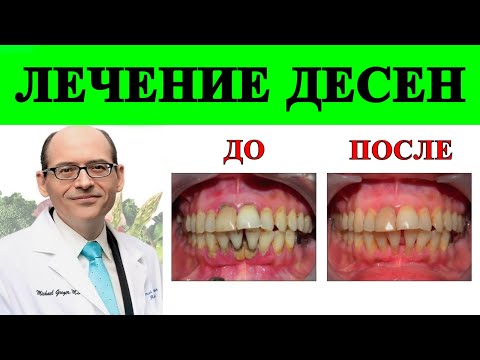 Лучшая пища для лечения Пародонта и Гингивита - доктор Майкл Грегер