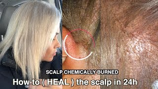 Severe Scalp Chemically Burned | How to heal the scalp after bleached  your hair ( it work )