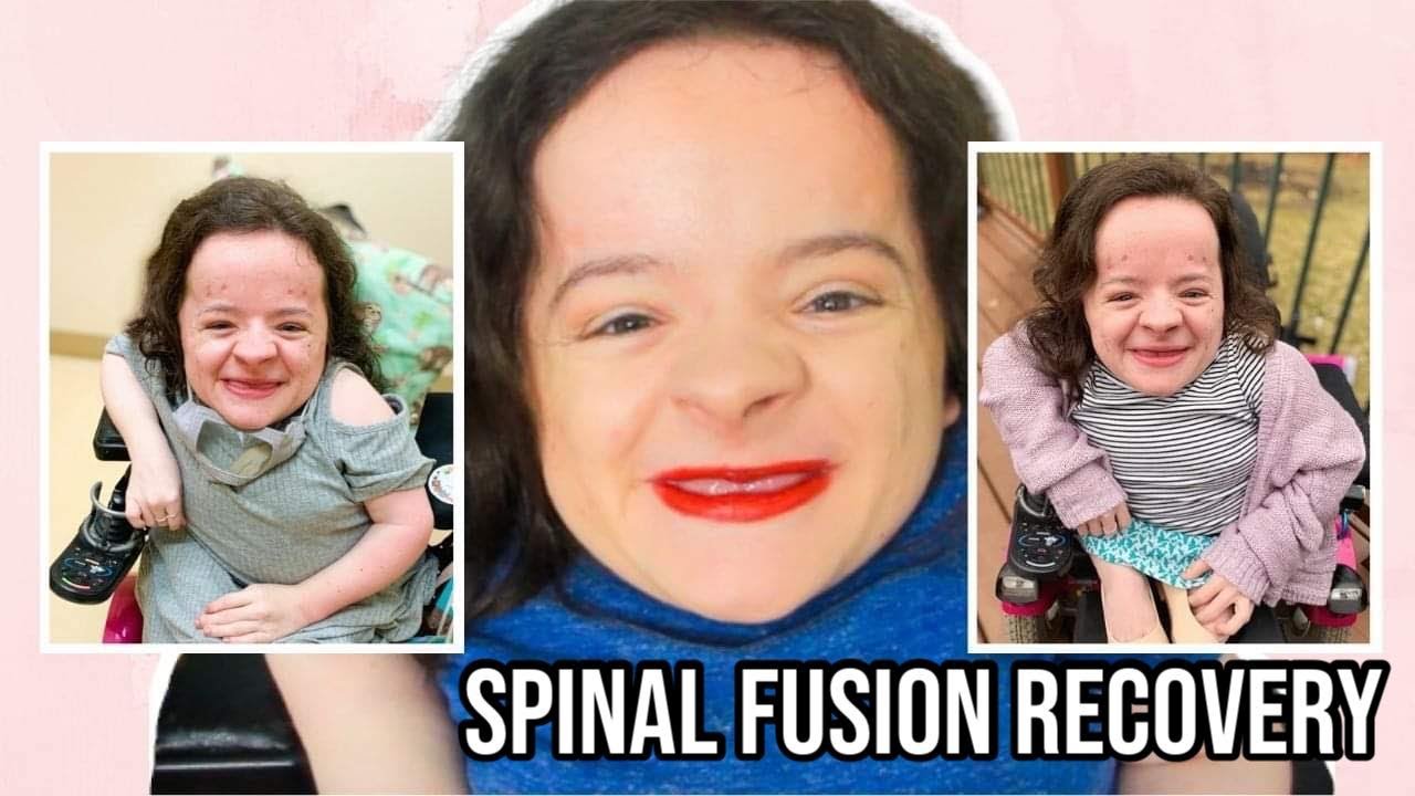 RECOVERY FROM A COMPLEX SPINAL FUSION WITH OSTEOGENESIS IMPERFECTA