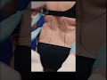Reno Liposuction Procedure Surgical Markings Dr Erez Dayan Avance Plastic Surgery